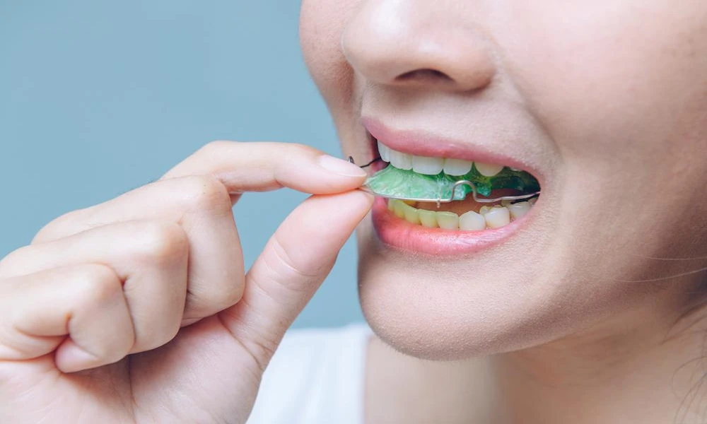 The Importance Of Retainers After Orthodontic Work